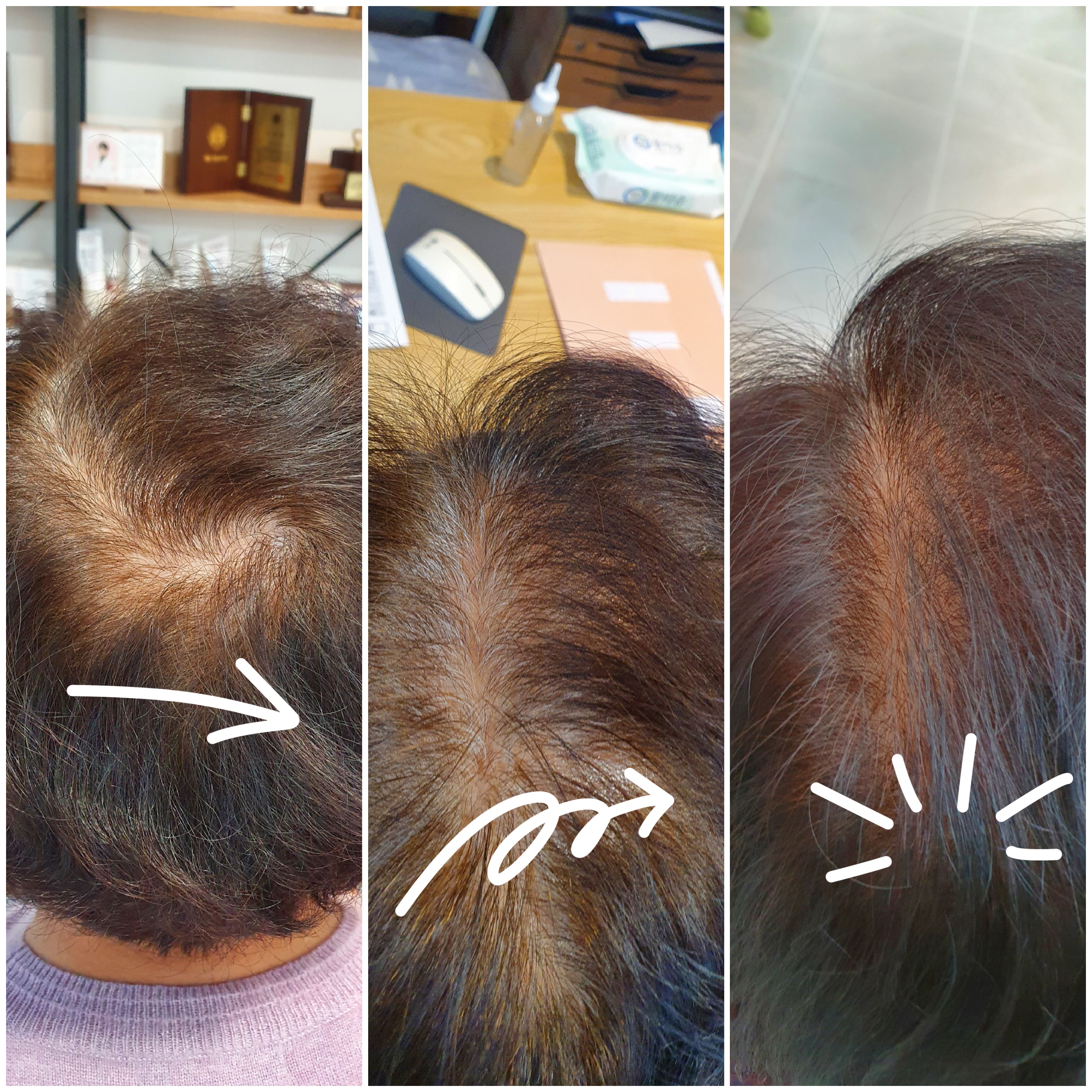 갱년기 탈모 관리 비포애프터 이미지