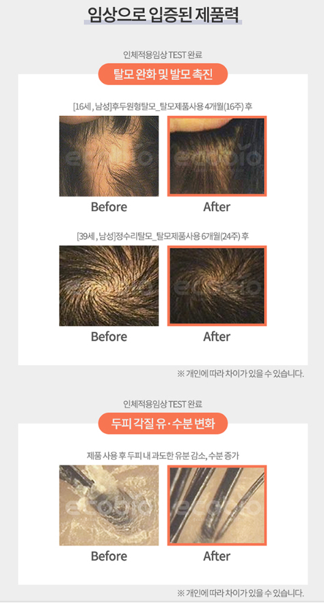 헤드스파K 앰플 사용 전후 임상 결과 비포 애프터