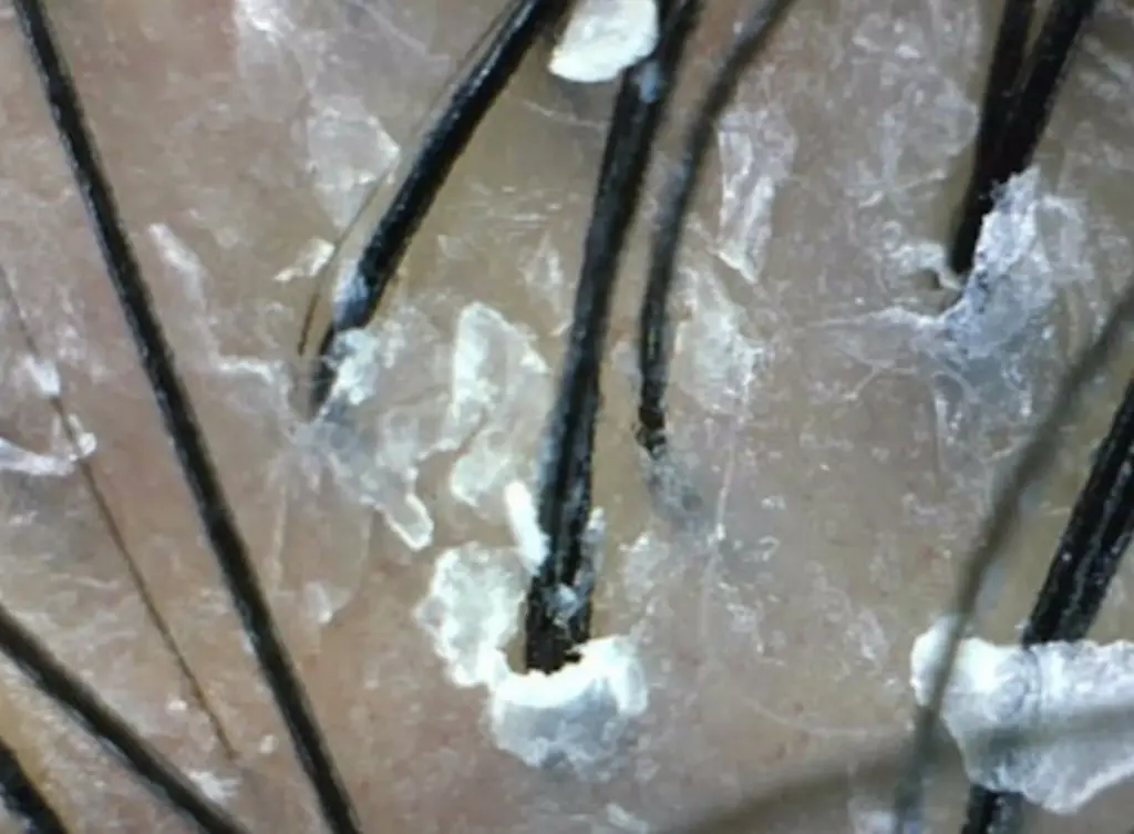 dandruff on hair follicles scalp