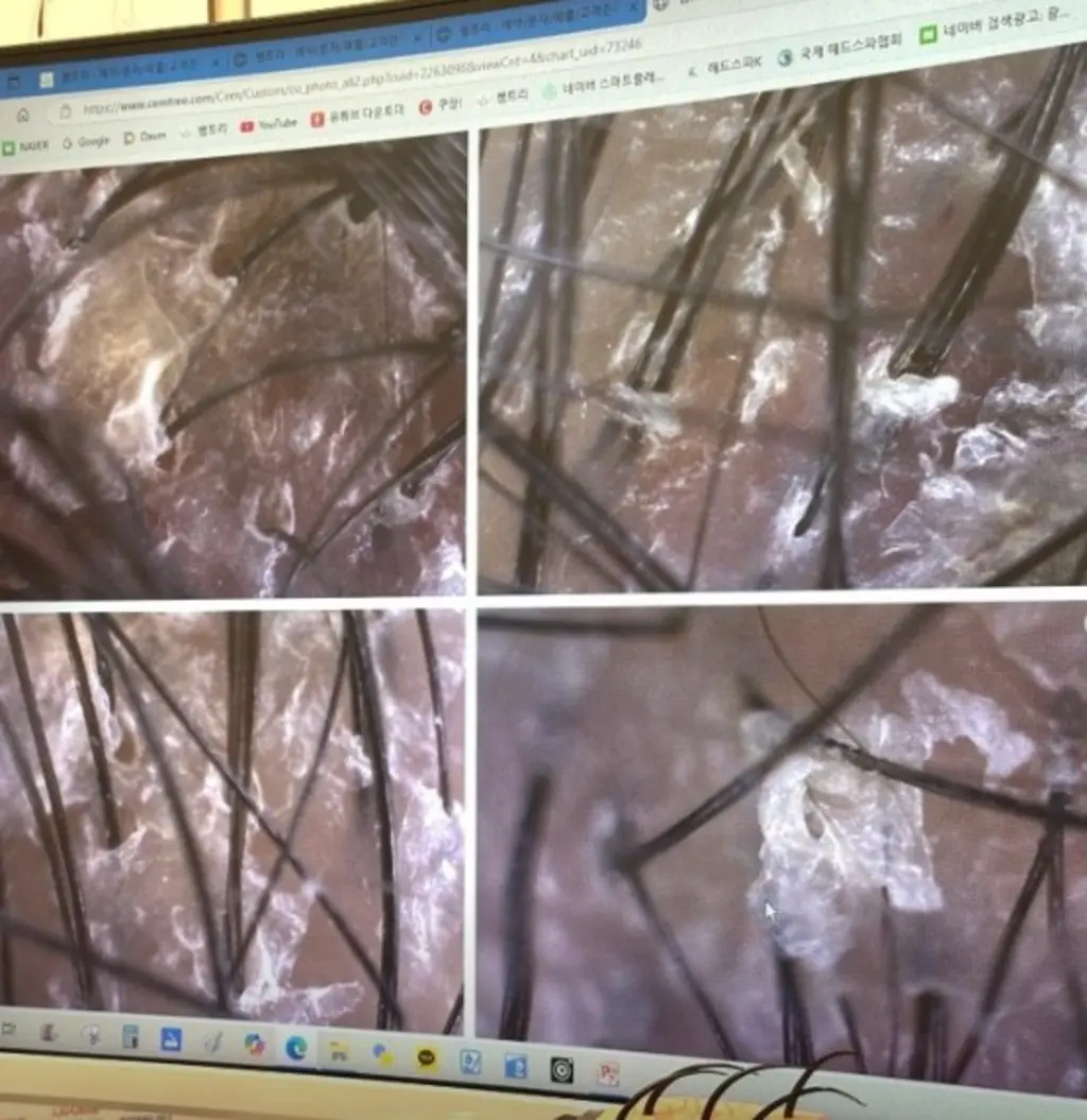 두피 비듬 근접 사진