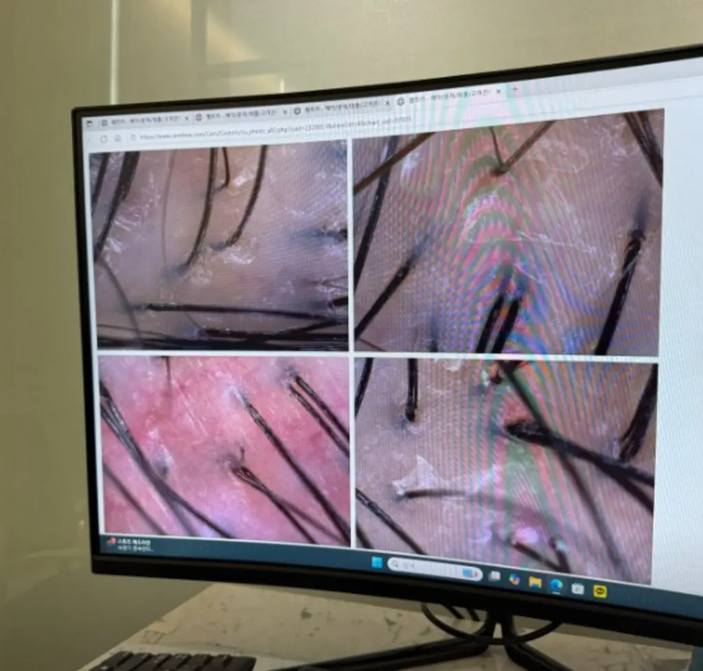 모낭 분석 확대