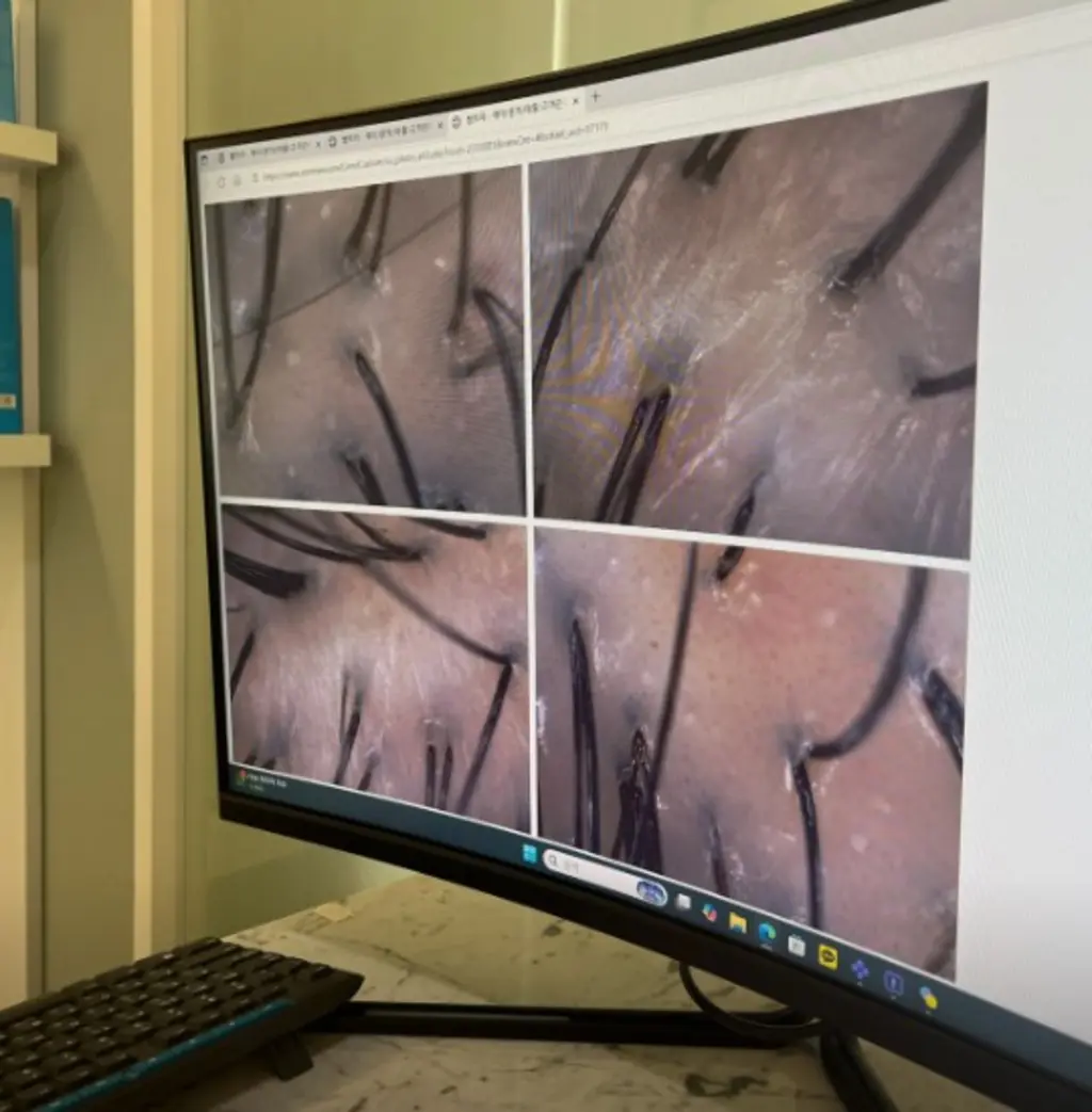 hair_follicle_checkup_on_screen_68295