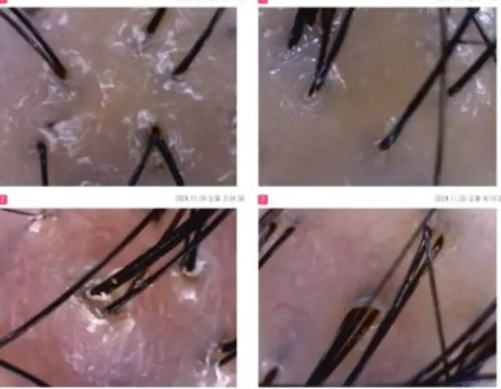 모낭 확대 모습