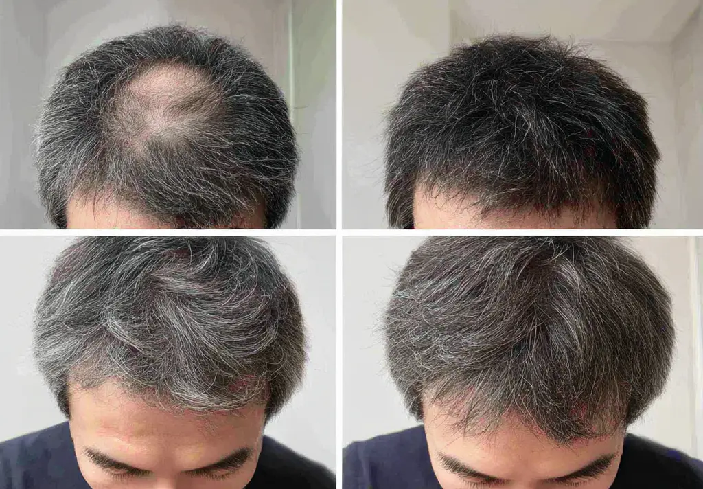 탈모 케어 후기