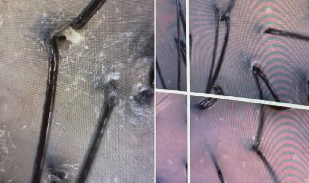 두피문신 시술 클로즈업