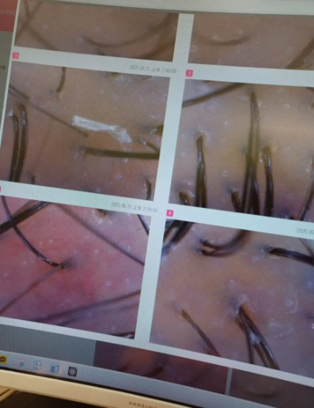 얇아지는 모발을 보여주는 두피 확대 이미지