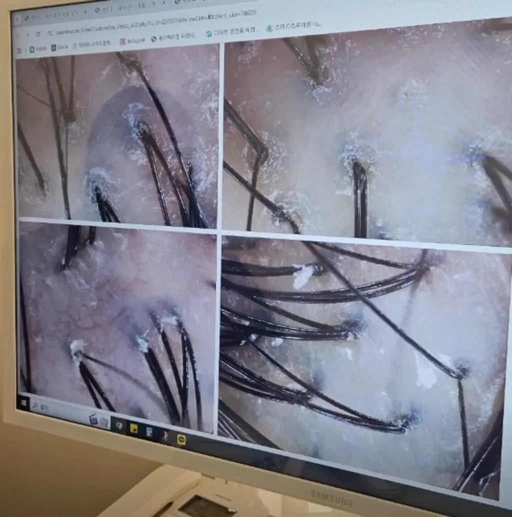 scalp analysis hair follicles view