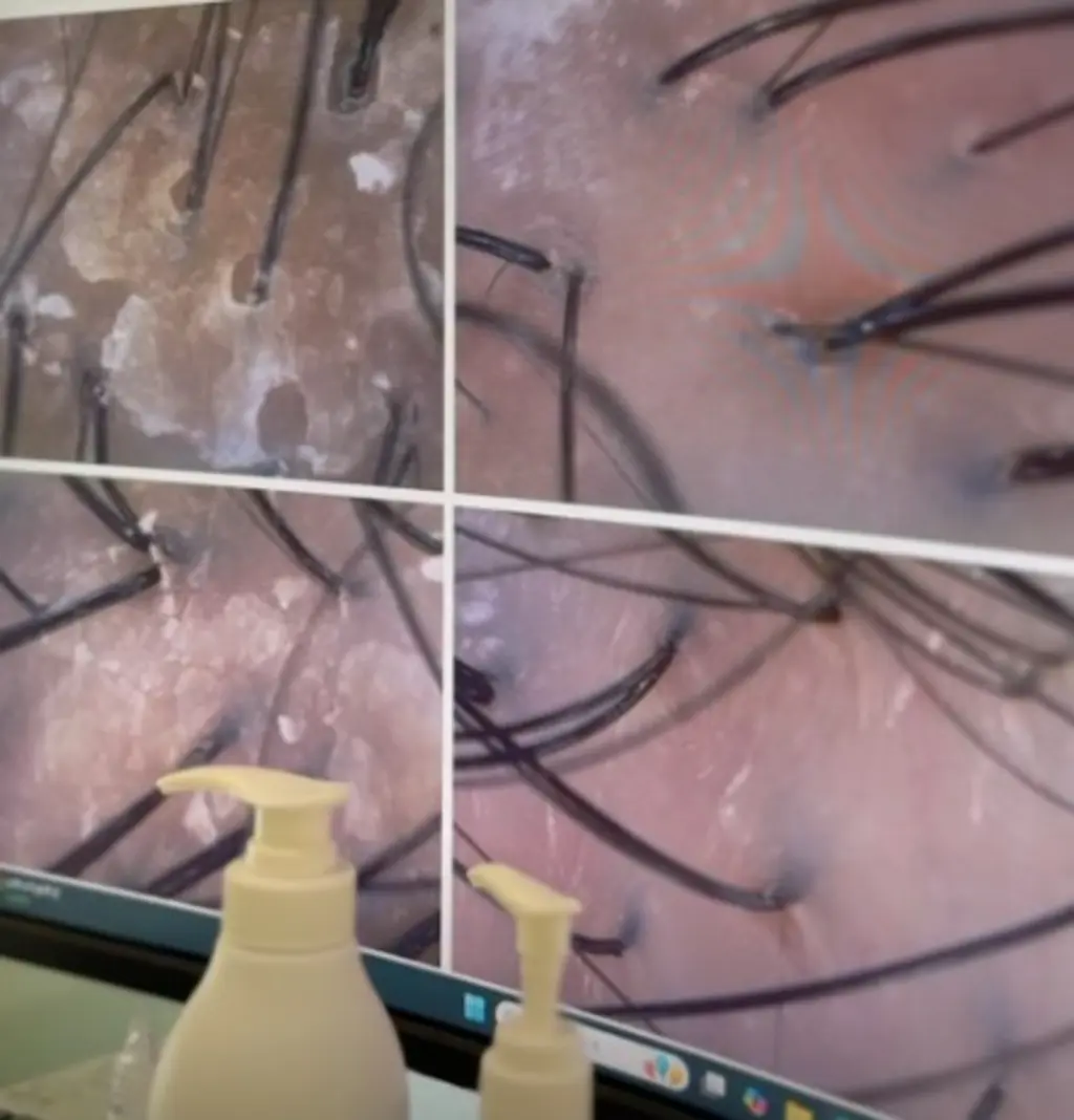 모낭을 통한 두피 분석