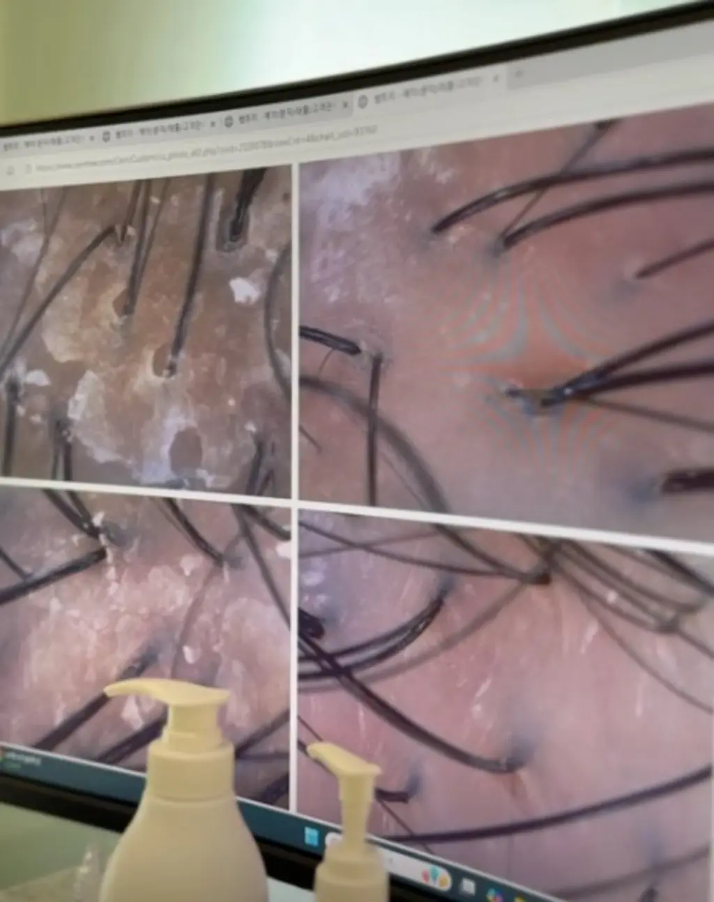 두피 모낭 확대 분석 이미지