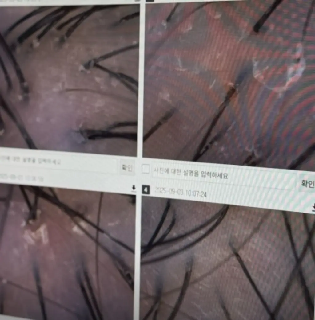 전문 기기로 두피를 정밀 진단하는 모습