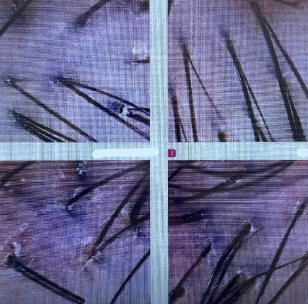 scalp_close_up_hair_follicles_08527