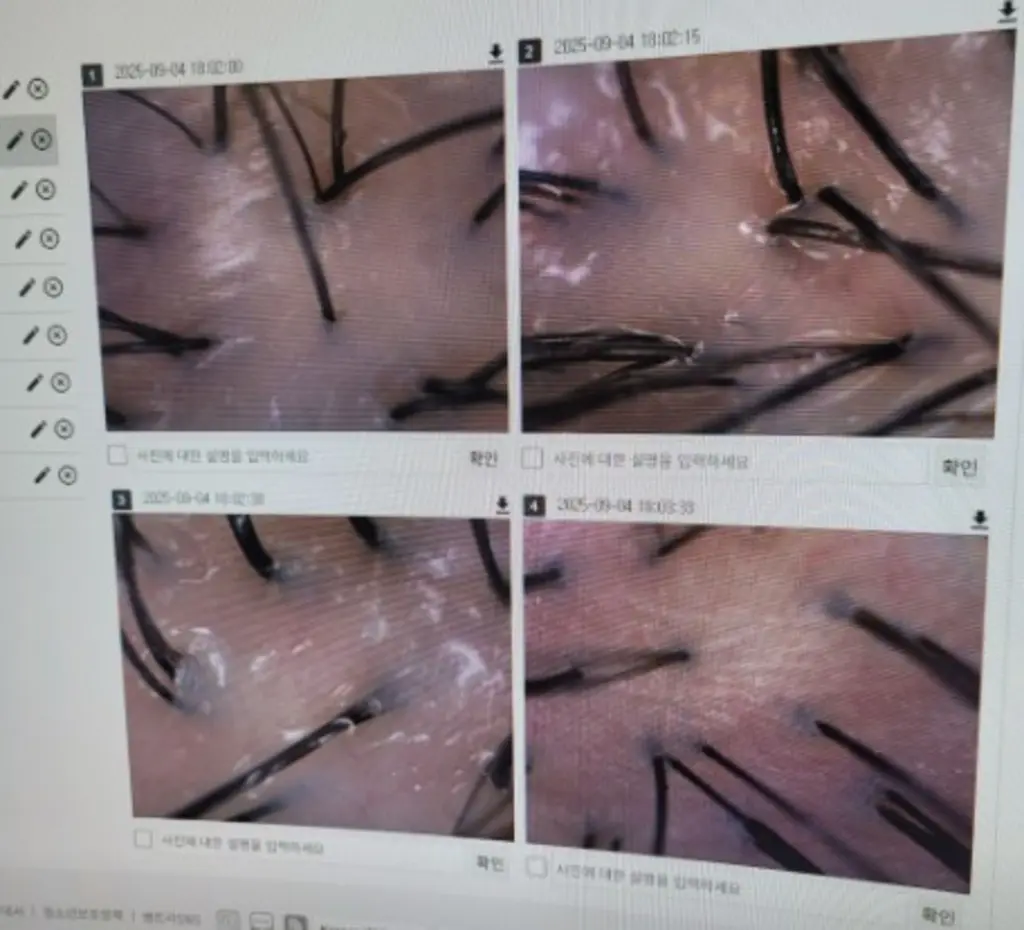 확대한 두피 모낭