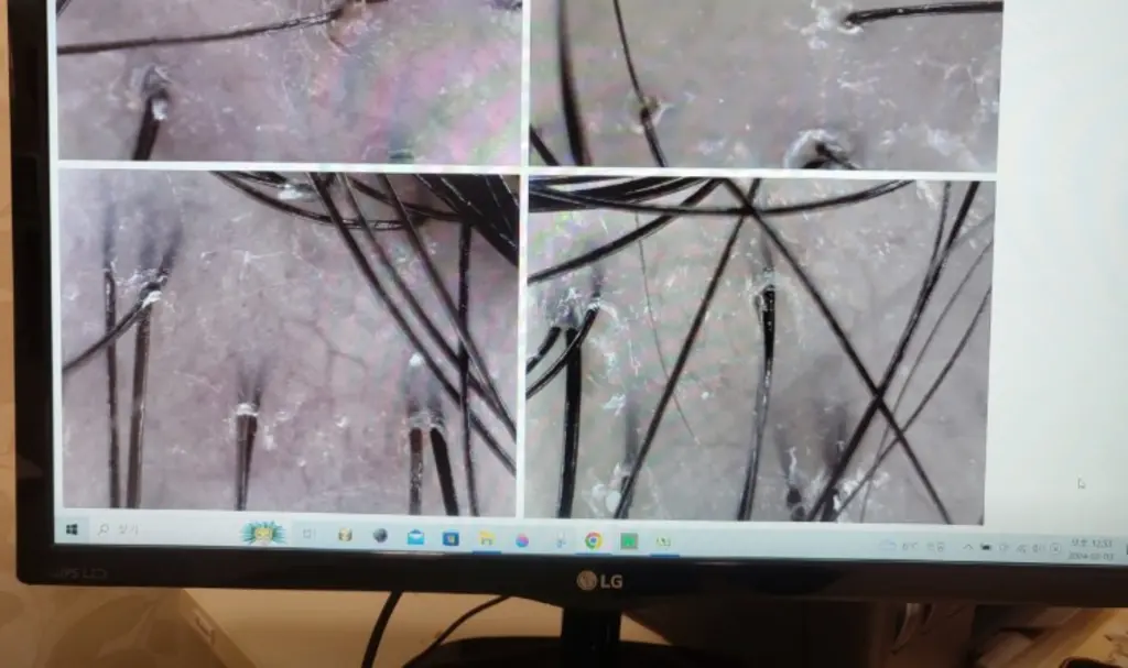 scalp_close_up_hair_follicles_43827