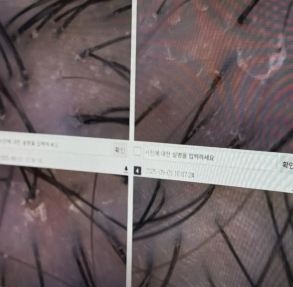 두피 근접 모발경 뷰