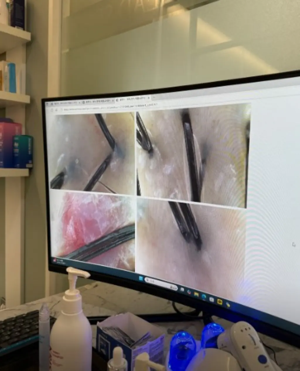 모니터에 나타난 두피 현미경 분석 이미지