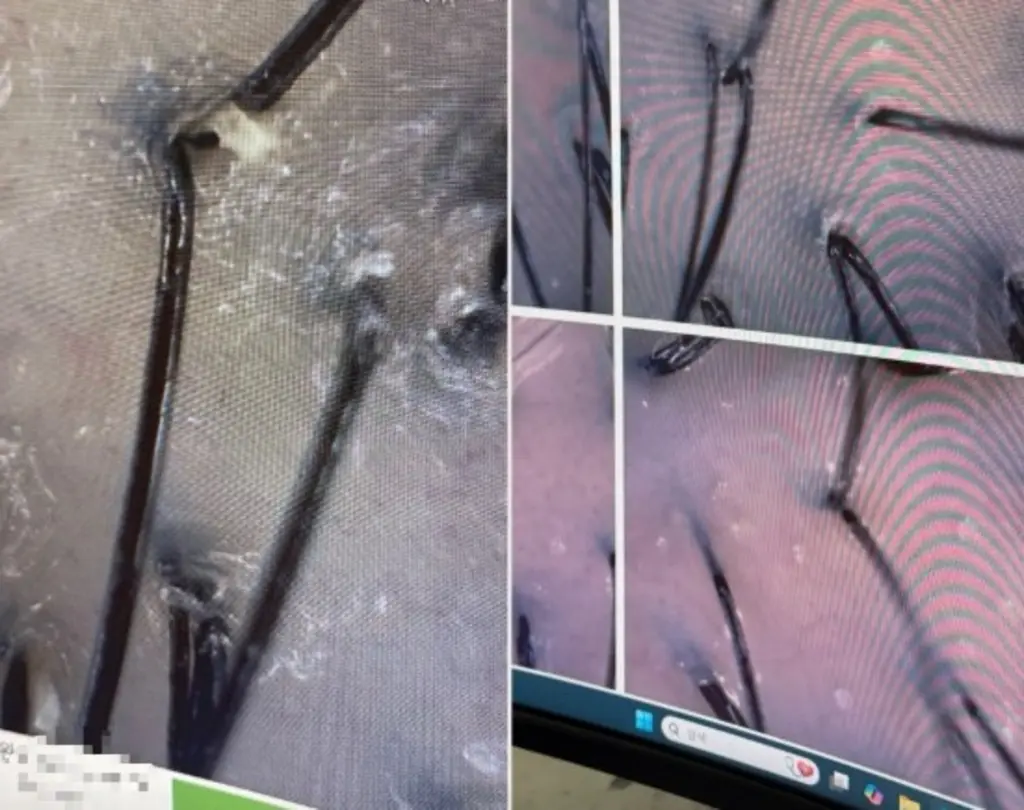 탈모 특징을 보여주는 두피 모낭 확대 사진